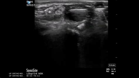 Wrist Ultrasound: Ganglion Cyst Aspiration and Injection - YouTube