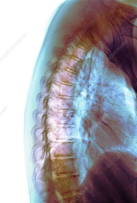 Osteoarthritis of the spine, X-ray - Stock Image - C038/7688 - Science ...