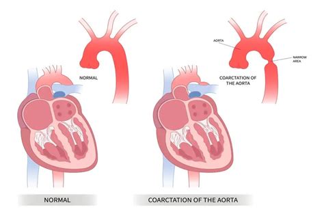 Coarctation of the Aorta: A Comprehensive Guide - Longmore Clinic