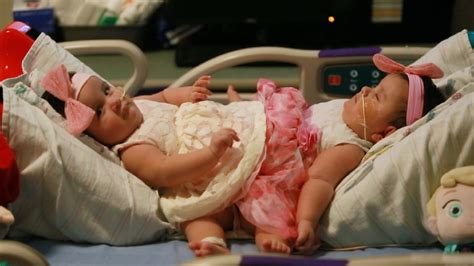 Conjoined sisters undergo rare separation surgery in Texas | KUTV