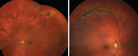 Can We Pre-empt Damage from Retinal Detachment?