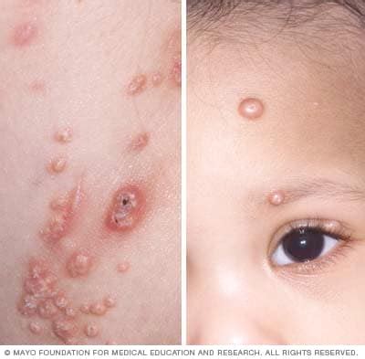 Molluscum Contagiosum 中文 - kaxijavis