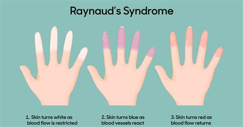 Raynaud's syndrome children - Children's National