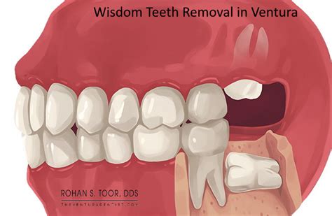 Ventura - Wisdom Teeth Removal - Cost, Symptoms, Recovery, Oral Surgery ...