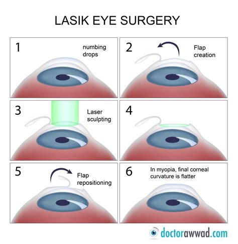 eyes - What happens in lasik operation? - Biology Stack Exchange