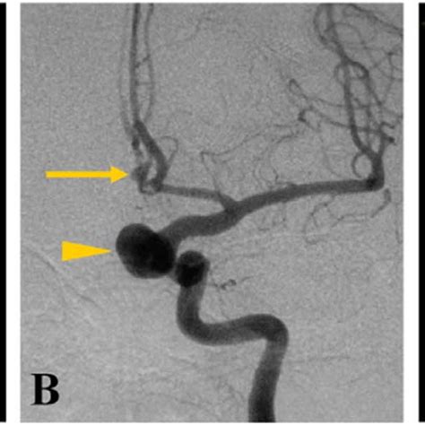 Aneurysm in the left anterior communicating artery in a 61-year-old ...