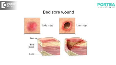 What all are the different types of wound dressing? | Portea Medical ...