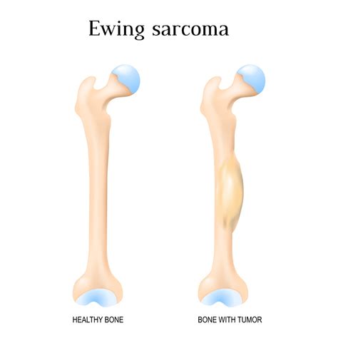 Ewing Sarcoma Treatment in Thailand - Almurshidi Medical Tourism Agency ...