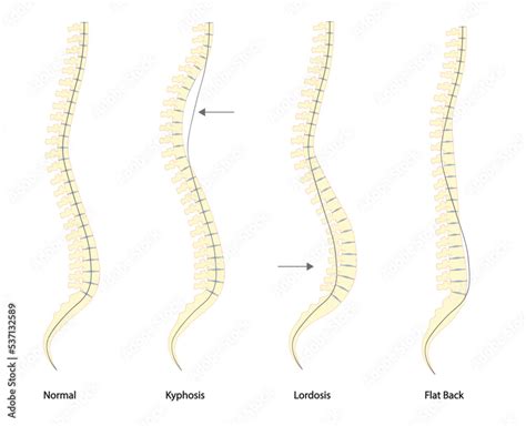 Spine deformity types and normal spine comparison. Lateral view of ...