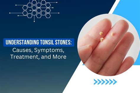 Understanding Tonsil Stones: Causes, Symptoms, Treatment, And More | by ...