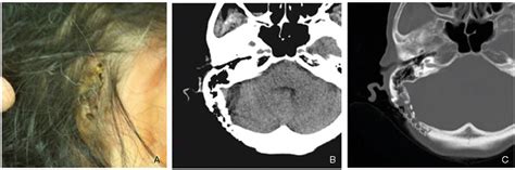 Figure 2 from Exposure of Titanium Mesh after Cranioplasty for ...