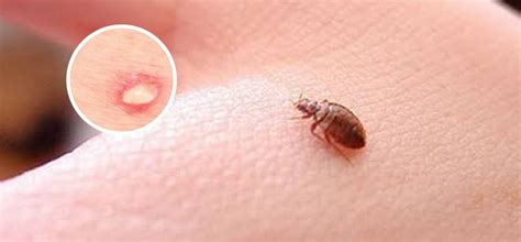 Tips For Bed Bugs Natural Pest Control | by Mick’s Pest Control Hobart ...