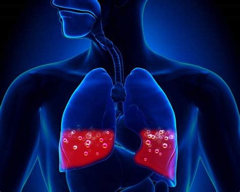 Device That Detects Congestion in the Lung Improves Heart Failure ...