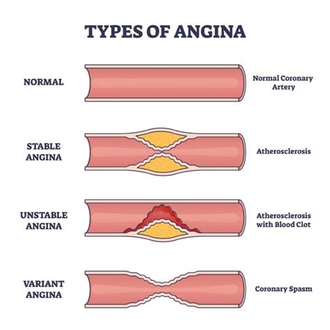 Angina Treatment & Symptoms, The Causes of Angina