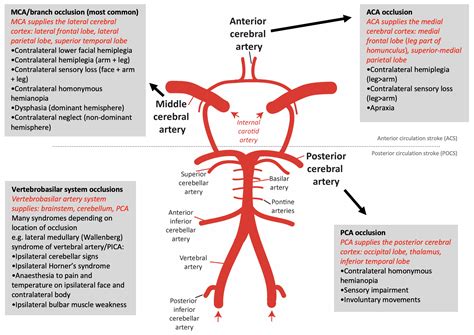 Stroke | OSCEstop | OSCE Learning