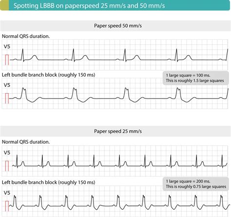 Left bundle branch block (LBBB): ECG criteria, causes, management – ECG ...