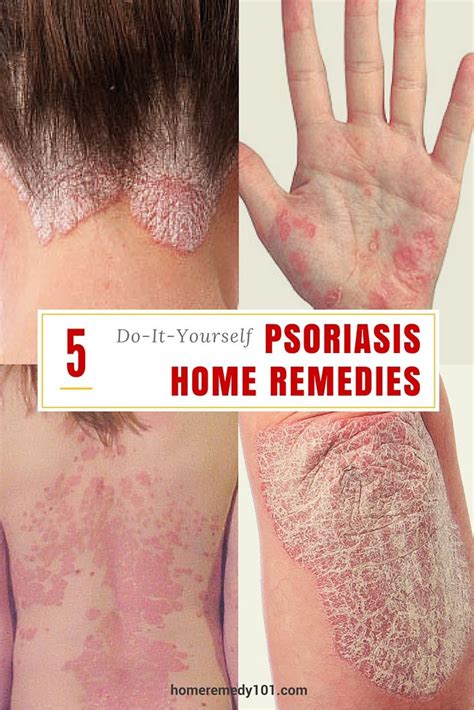 5 Do-It-Yourself Psoriasis Home Remedies | Home remedies, Psoriasis ...