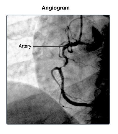 Cardiac Catheterization | Johns Hopkins Medicine