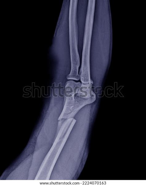 Xray Photo Fracture Distal Humerus Stock Photo 2224070163 | Shutterstock