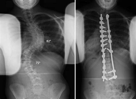 Surgical Treatment for Scoliosis - OrthoInfo - AAOS