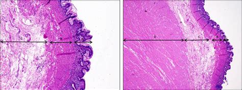 Duplication cyst most compatible with jejunum. | Download Scientific ...