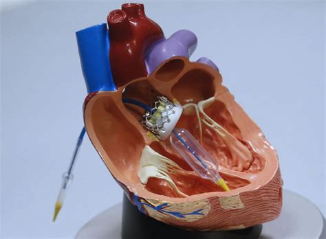 Aortic valve replacement widens heart patients' options | Health ...