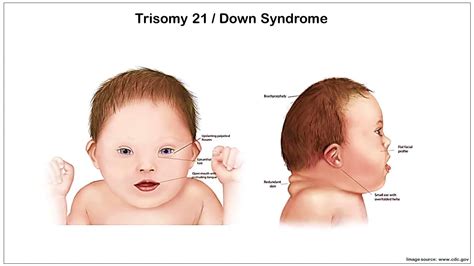 Down Syndrome/Trisomy 21- Explained