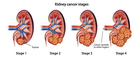 Kidney Cancer (Renal Cancer) Signs, Symptoms | Saint John’s Cancer ...