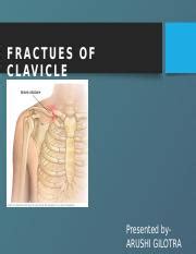 Fractures of the Clavicle: Causes, Symptoms, and Treatment | Course Hero