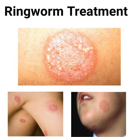 Best Medications For Ringworm Treatment - Public Health