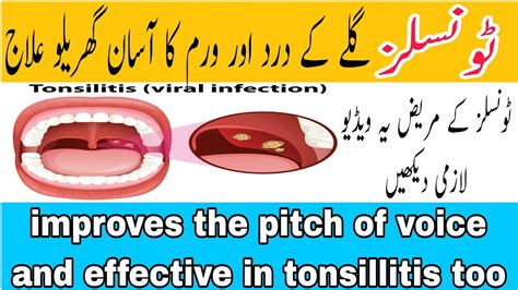 Tonsils Ka ilaj | tonsils infection||galy Ka dard|| tonsils symptoms ...