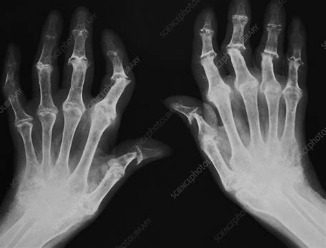 Arthritic hands, X-ray - Stock Image M110/0679 - Science Photo Library