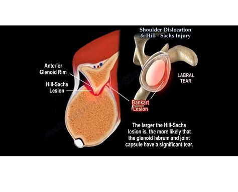 Shoulder Dislocation and Hill Sach’s Lesion — OrthopaedicPrinciples.com