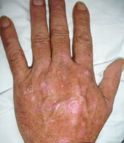 Atrophic rash in a hepatitis C patient - The Clinical Advisor