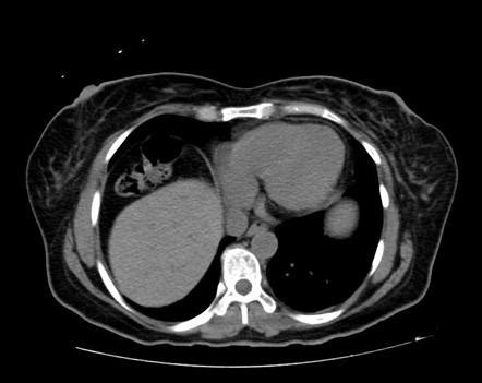 Colonic interposition | Radiology Case | Radiopaedia.org