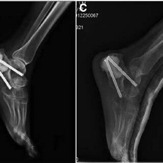 The arthrodesis healed successfully without fixation failure in 2 years ...