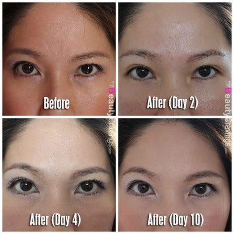 Botox Review at Cutis Medical Laser Clinics | $208 to get rid of ...