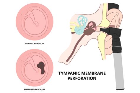 Ruptured Tympanic Membrane Trauma