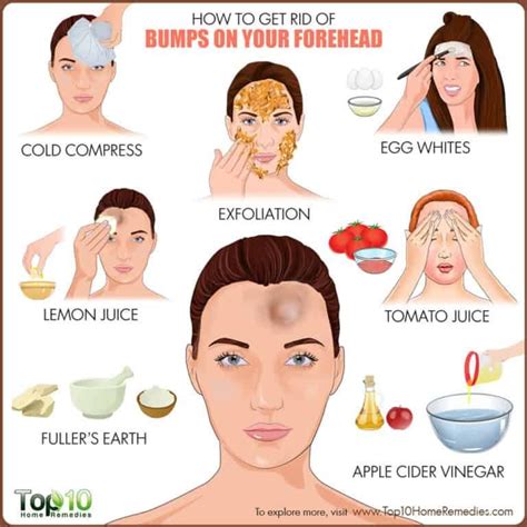 Bumps on Forehead: 8 Home Remedies to Reduce It | Forehead bumps ...