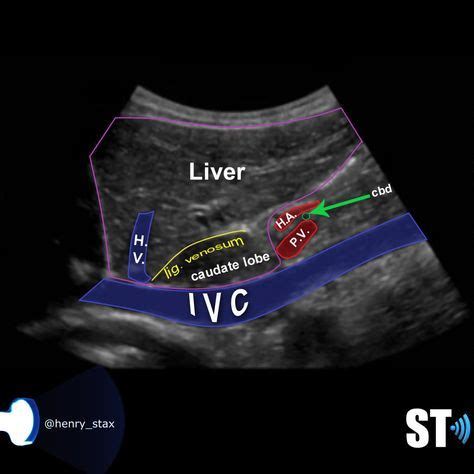 49 LIVER ideas in 2021 | liver, ultrasound, diagnostic medical sonography