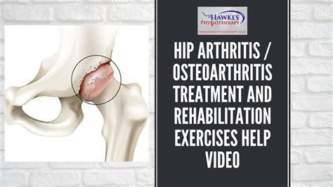 Hip arthritis / osteoarthritis treatment and rehabilitation exercises ...