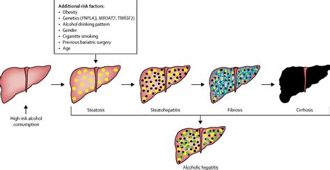 Alcoholic Hepatitis Liver