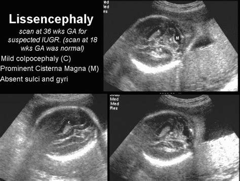 Ultrasound in Lissencephaly