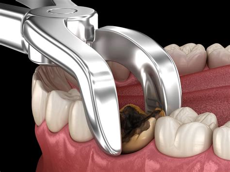 Cost to Extract a Tooth With & Without Insurance