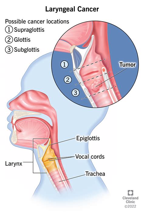 Understanding Laryngeal Cancer: Symptoms, Treatment, And Prevention ...