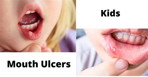 How to Prevent Mouth ulcers in child - Dental Care Tips