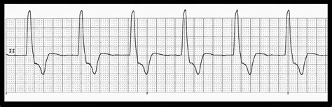 Float Nurse: EKG Rhythm Quiz 253