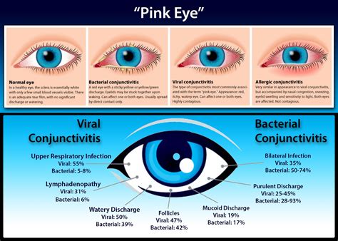 Pin on Eye Health Tips