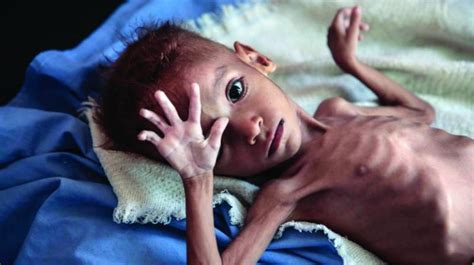 Malnutrition in South Asia – A Critical Reappraisal - Cherrubics