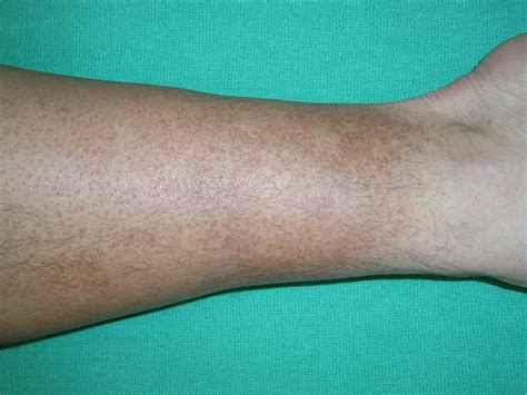 Discoloration of lower legs | MDedge Family Medicine